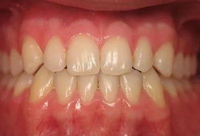 Close-up of human teeth, showing a full set of mostly straight, white teeth in a pink gumline.