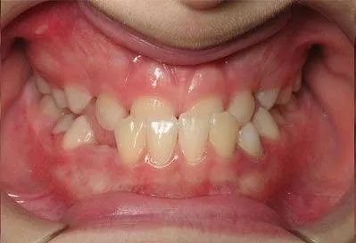 Close-up of a child's mouth showing crooked, crowded teeth and healthy pink gums.