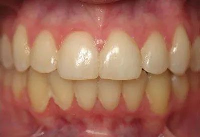 Close-up of human teeth, showing a row of upper and lower teeth, with healthy pink gums.