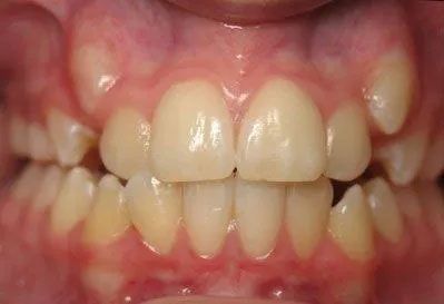 Close-up of a person's teeth showing misalignment. Some teeth are slightly yellow.