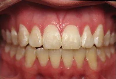 Close-up view of a person's teeth, showing upper and lower rows of teeth. Gums are pink.