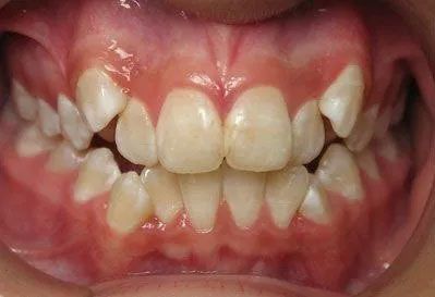 Close-up of teeth with mild to moderate crowding. Gums are pink.