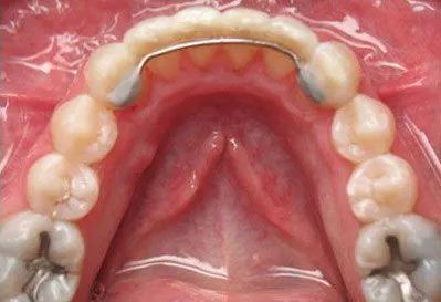 Upper dental arch with retainer in place, showcasing teeth and palate.