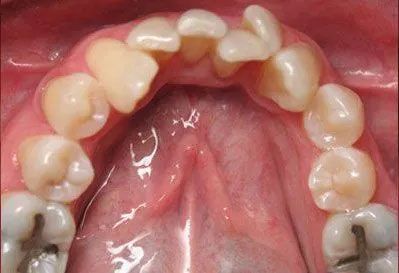 Upper teeth with irregular spacing and varied coloration visible inside the mouth.