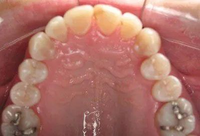 Interior view of a mouth with upper teeth visible. Some teeth have metal fillings, and all are set against pink gums.