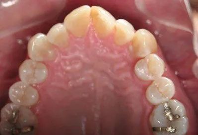 Upper dental arch with teeth; some teeth have fillings. Pink gums and palate.