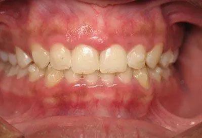 Close-up of teeth with slightly misaligned upper and lower arches. Gums are visible and slightly red.