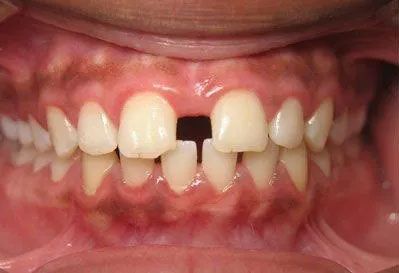 Close-up of a person's mouth with a gap between front teeth. Other teeth visible, pink gums.