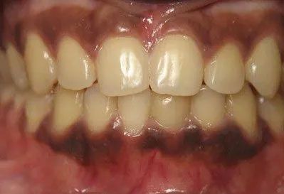 Close-up of human teeth, showing a full set with yellowed enamel. The gums appear dark and inflamed.