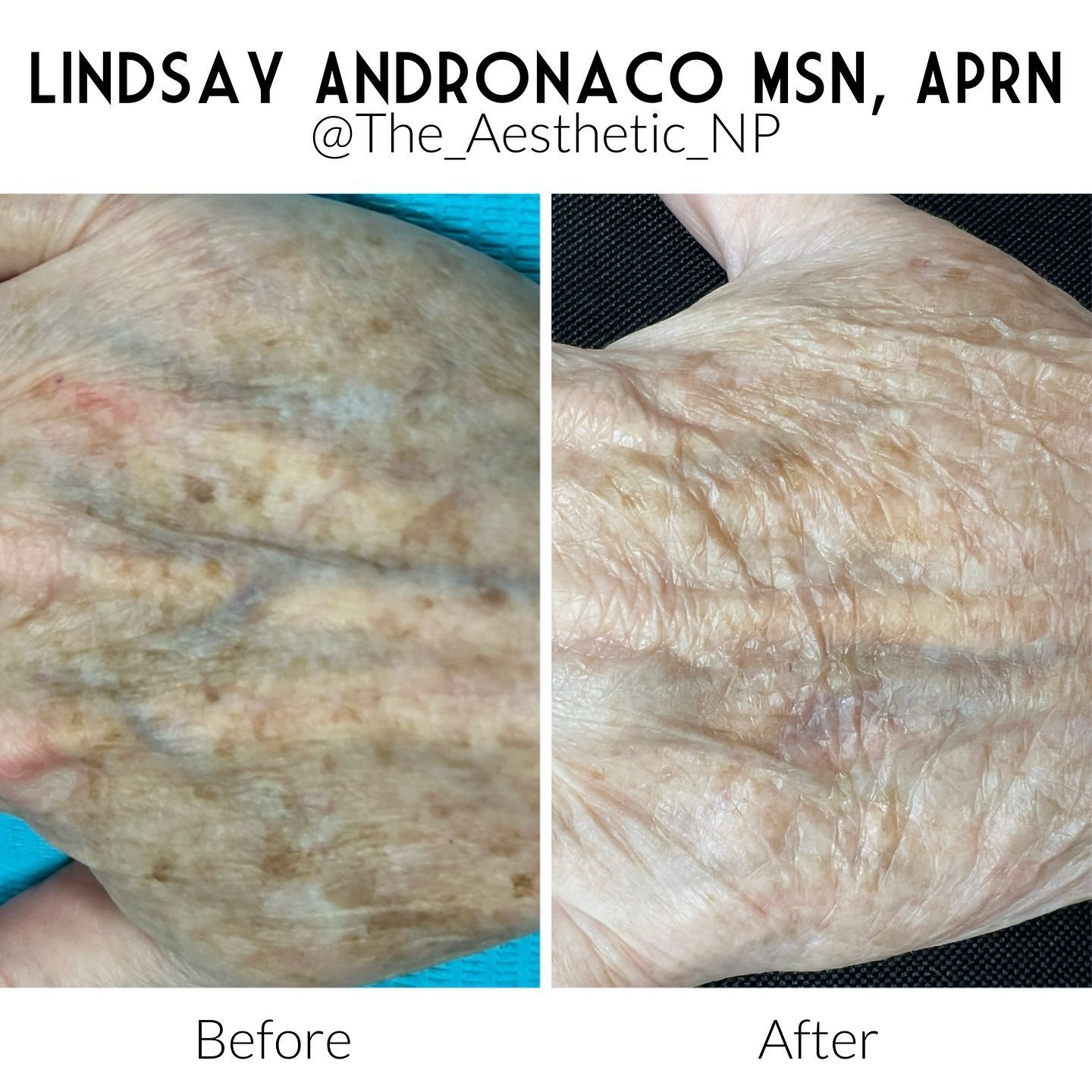 A before and after photo of a person 's hand.