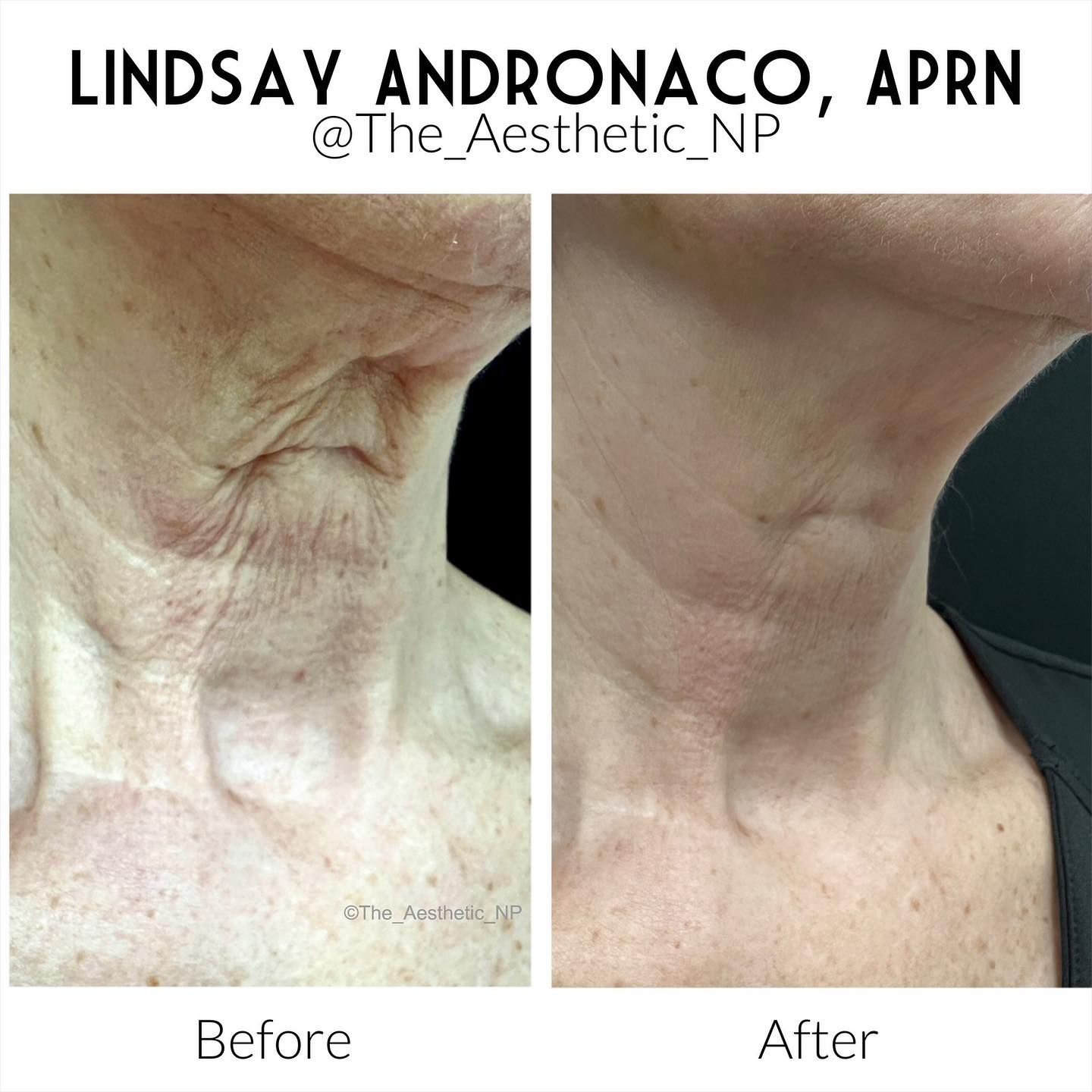 before and after of neck skin tightening