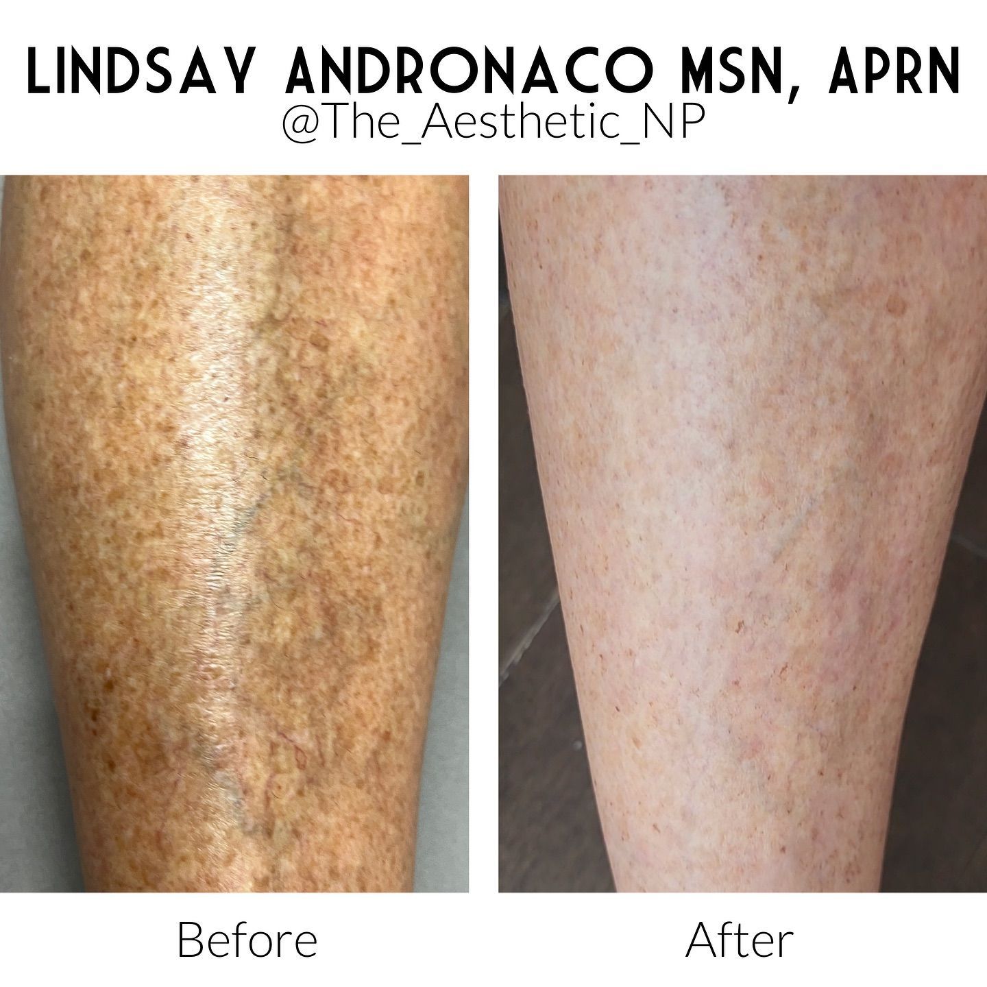 A before and after photo of a person 's leg