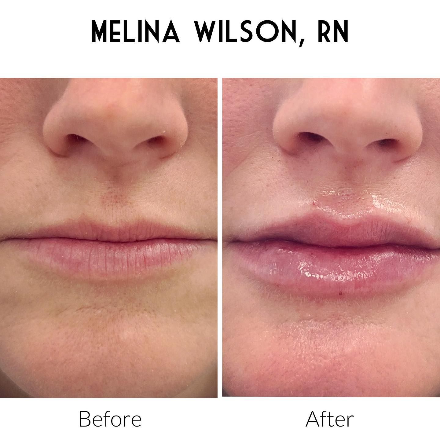 A before and after photo of a woman 's lips by melina wilson , rn.