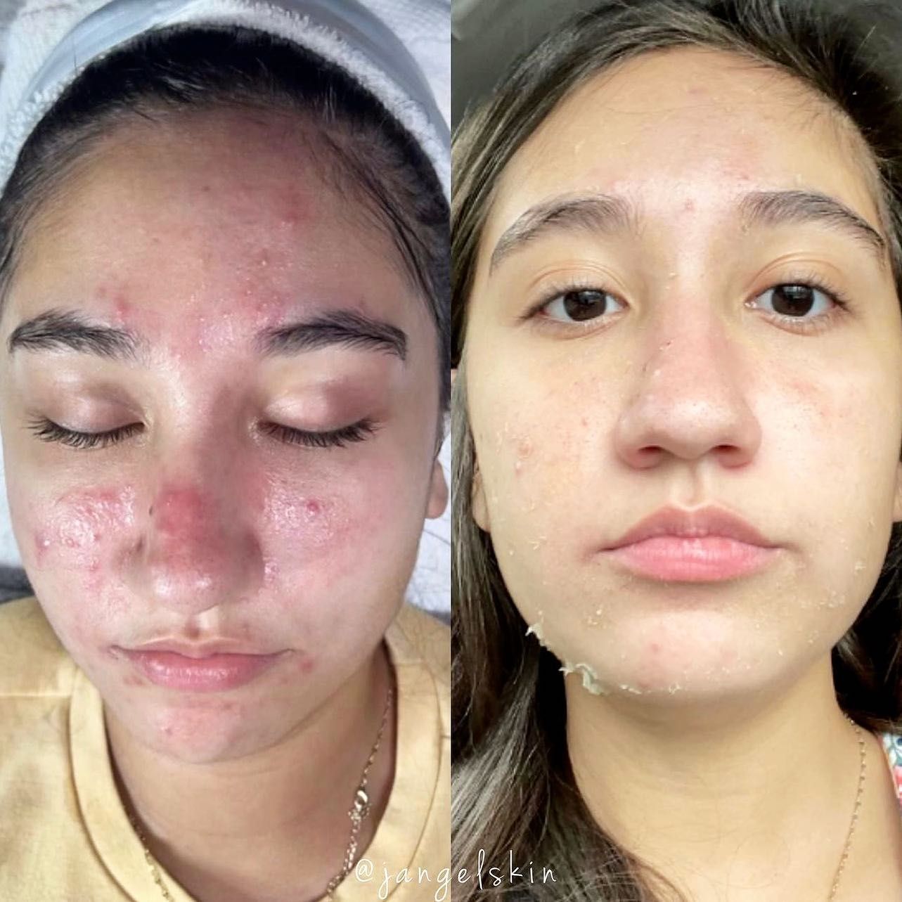 A before and after photo of a woman 's face with acne.
