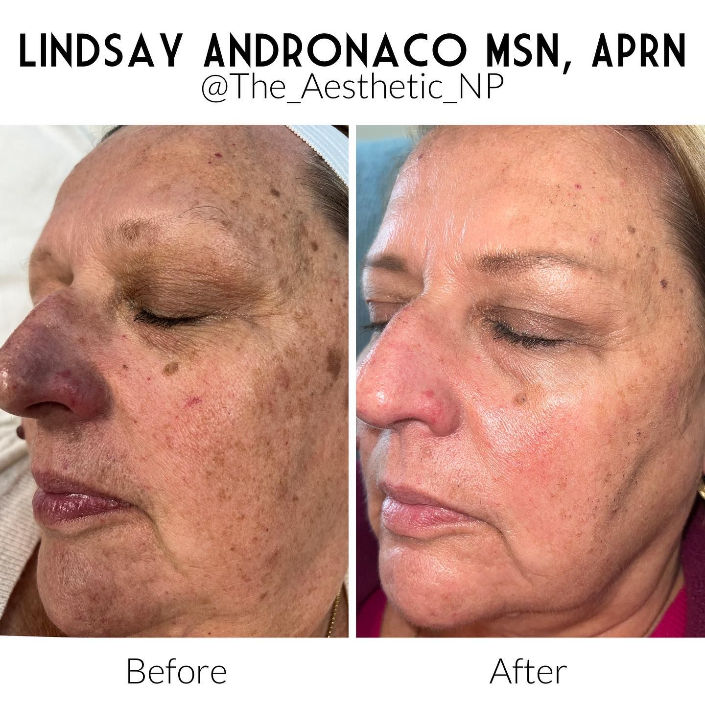 A before and after photo of a woman 's face.