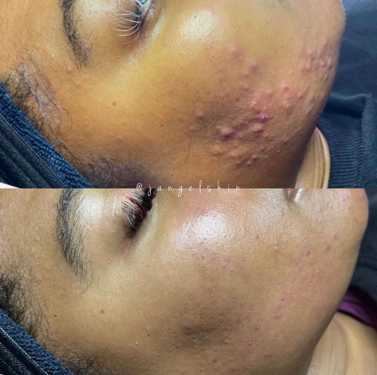 A before and after photo of a woman 's face with acne.