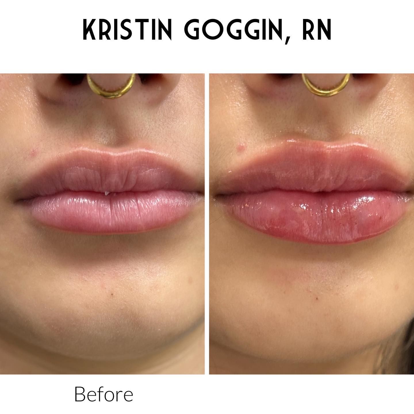 A before and after photo of a woman 's lips.