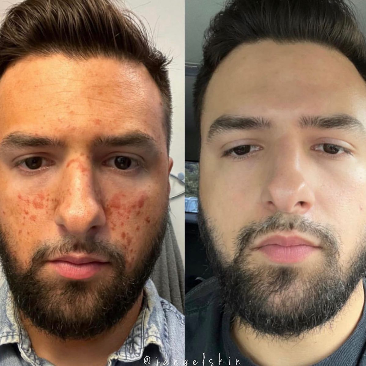 A man with a beard has acne on his face.