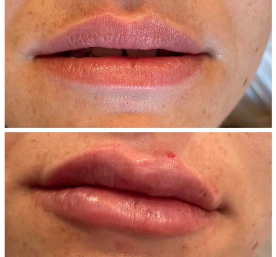 Juvederm lip augmentation before and after
