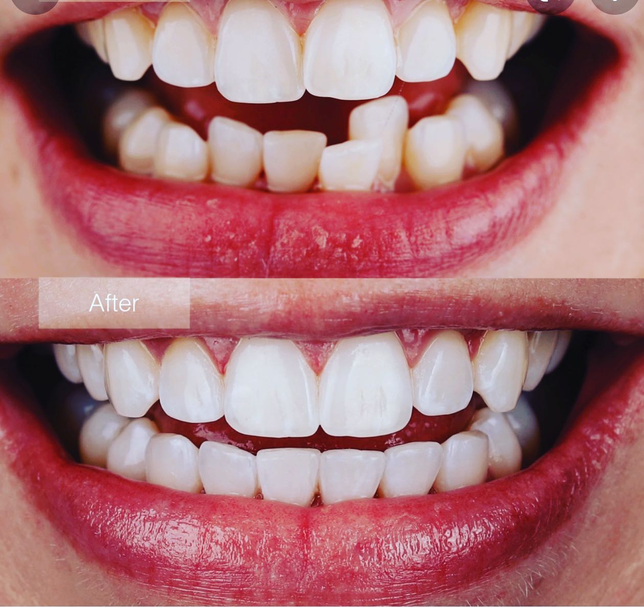 Teeth alignment before and after