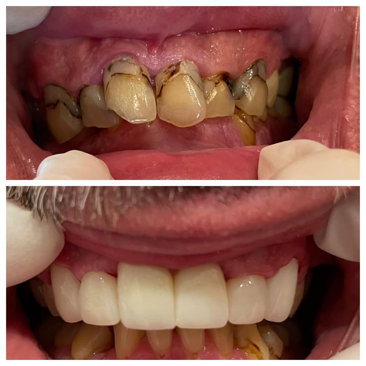 Teeth alignment before and after