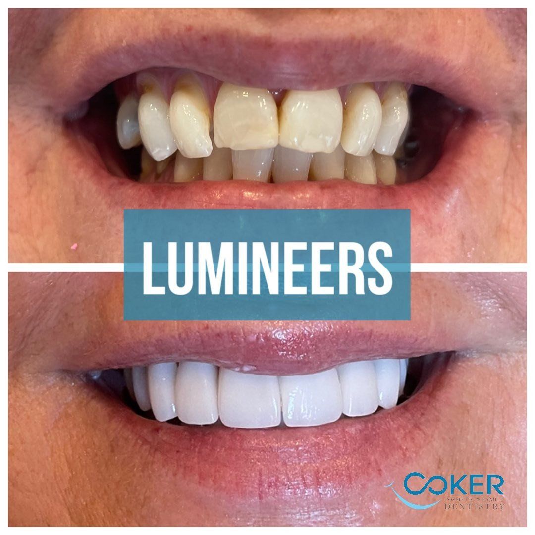Teeth Lumineers before and after