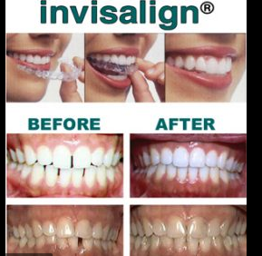 Teeth invisalign