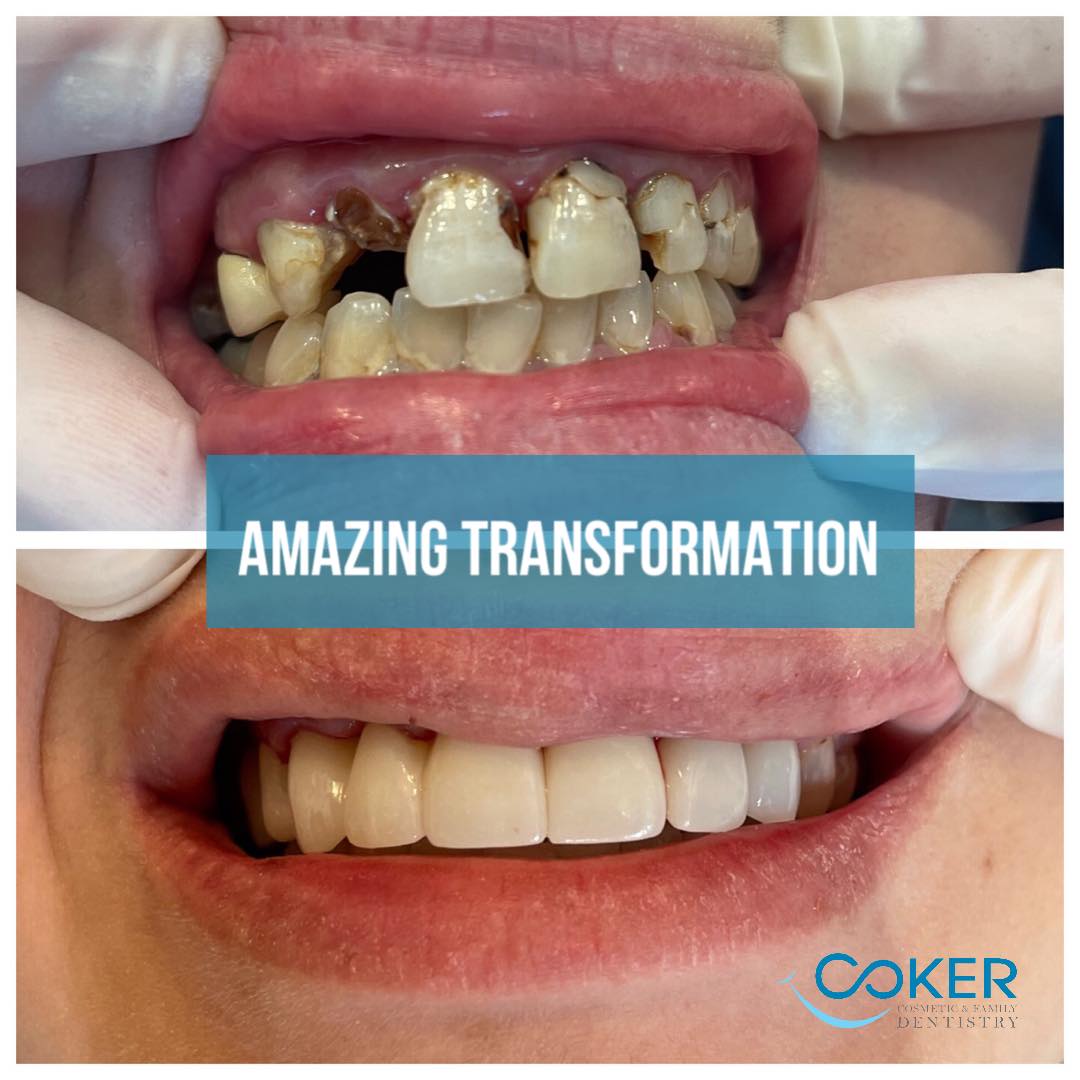 Teeth restoration before and after