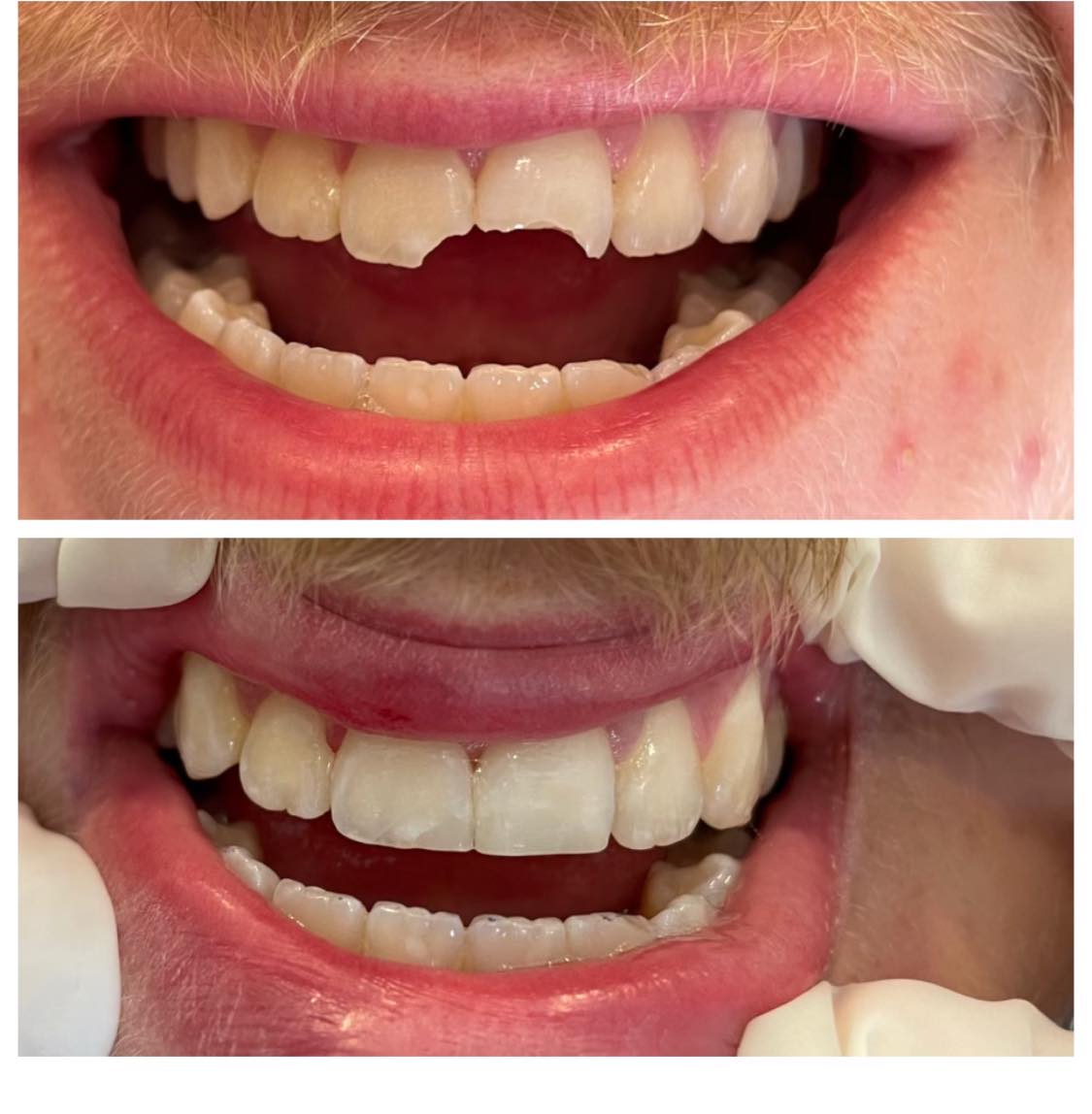 Teeth restoration before and after