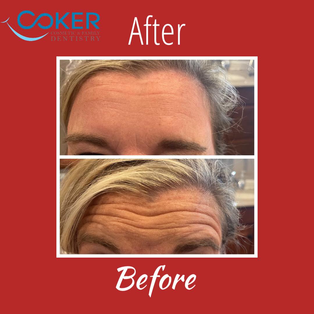 Botox treatment for forehead lines