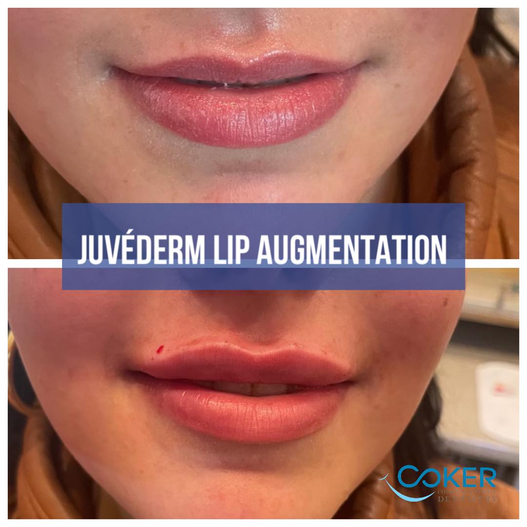 Juvederm lip augmentation before and after
