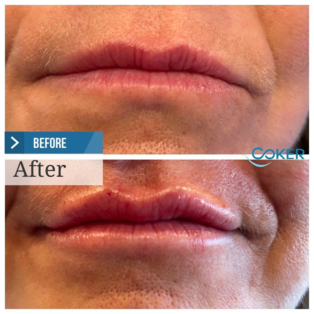 Juvederm lip augmentation before and after
