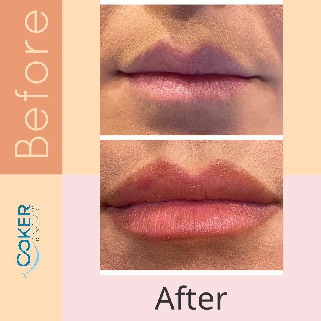 Juvederm lip augmentation before and after