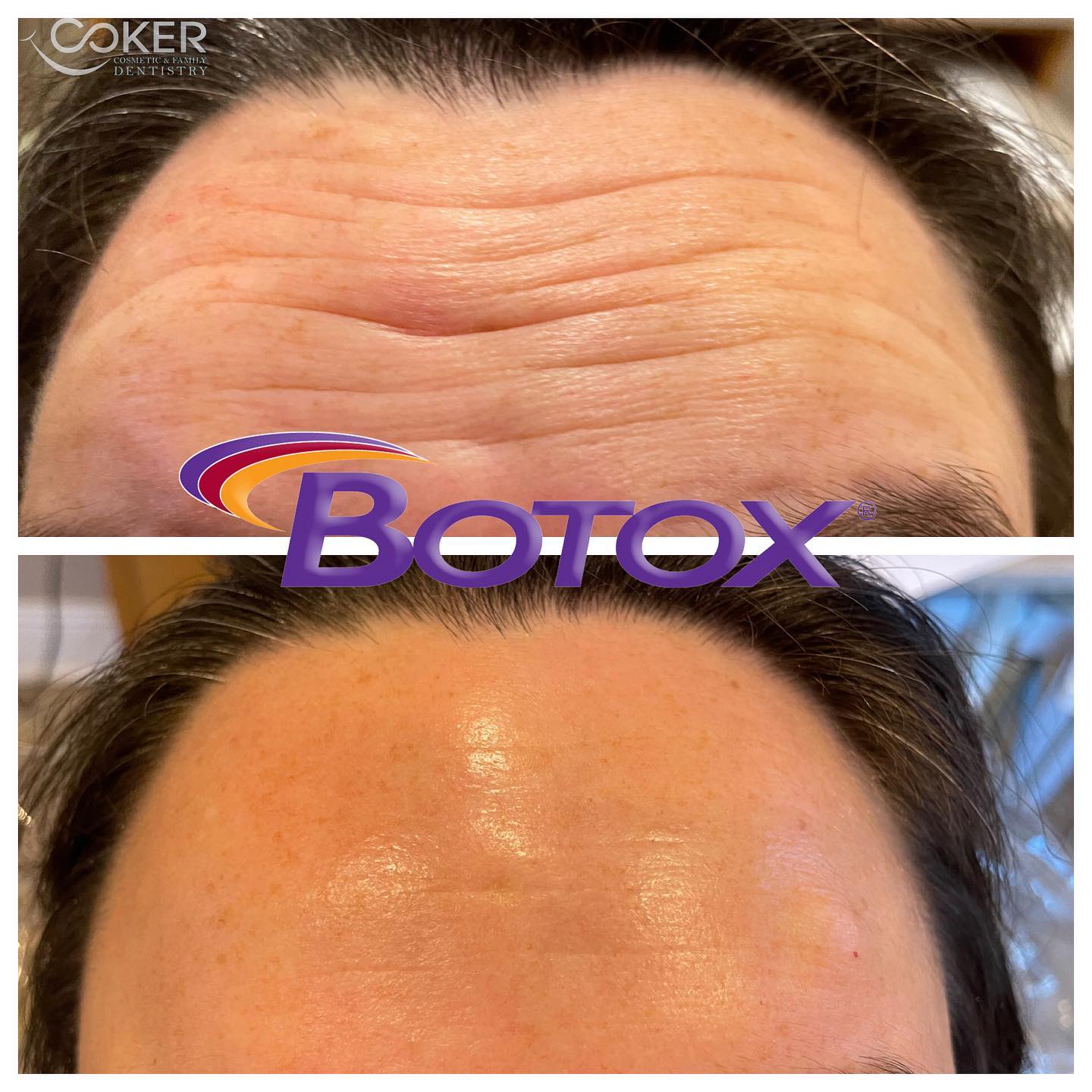 Botox treatment for forehead lines