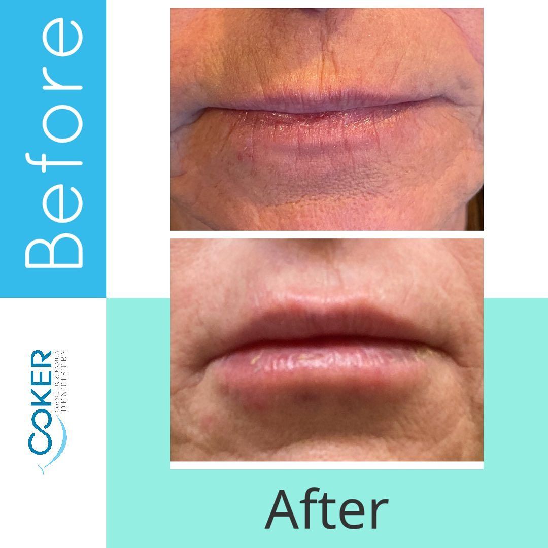 Juvederm lip augmentation before and after