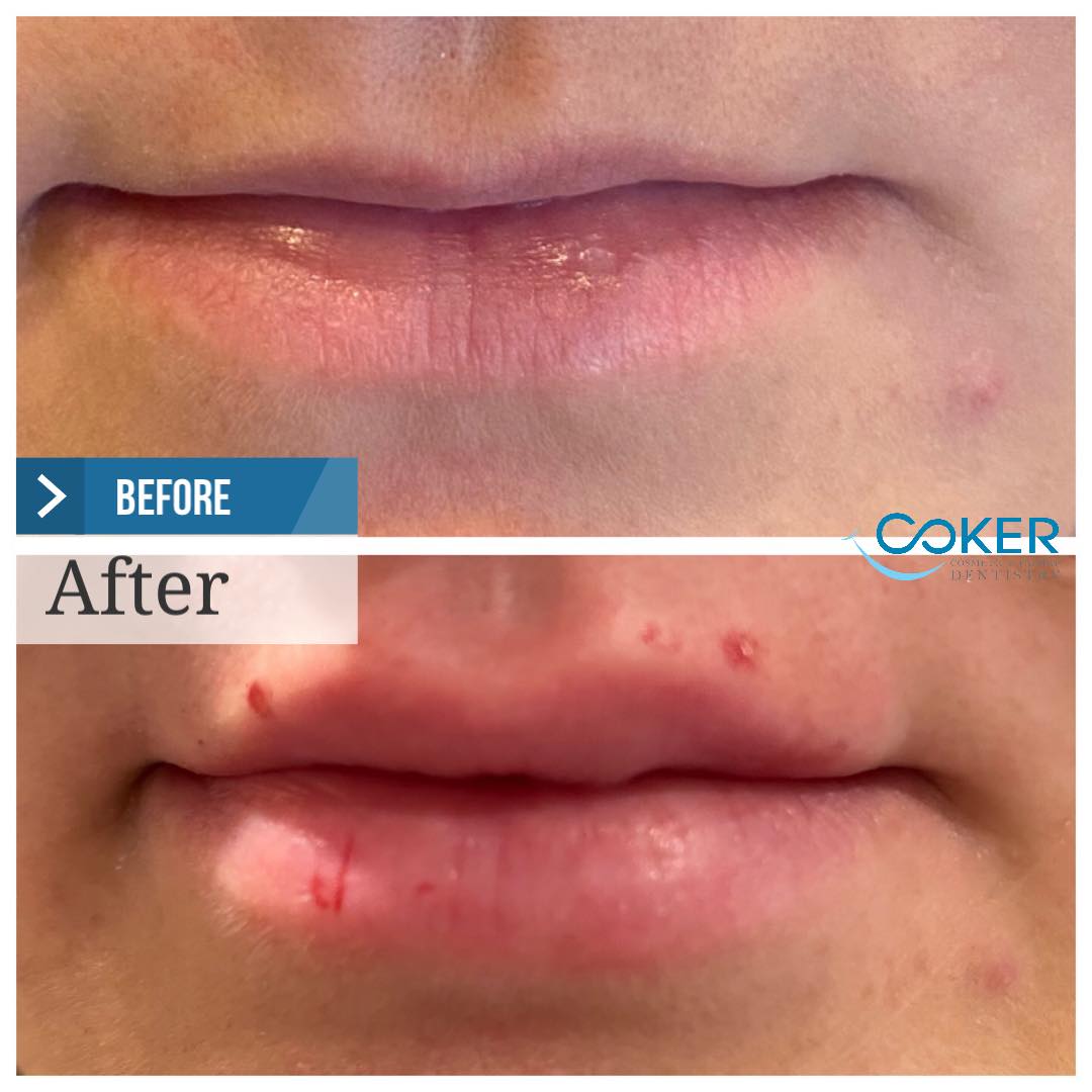 Juvederm lip augmentation before and after