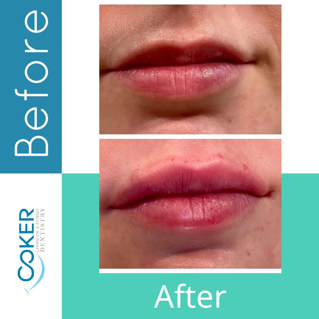 Juvederm lip augmentation before and after