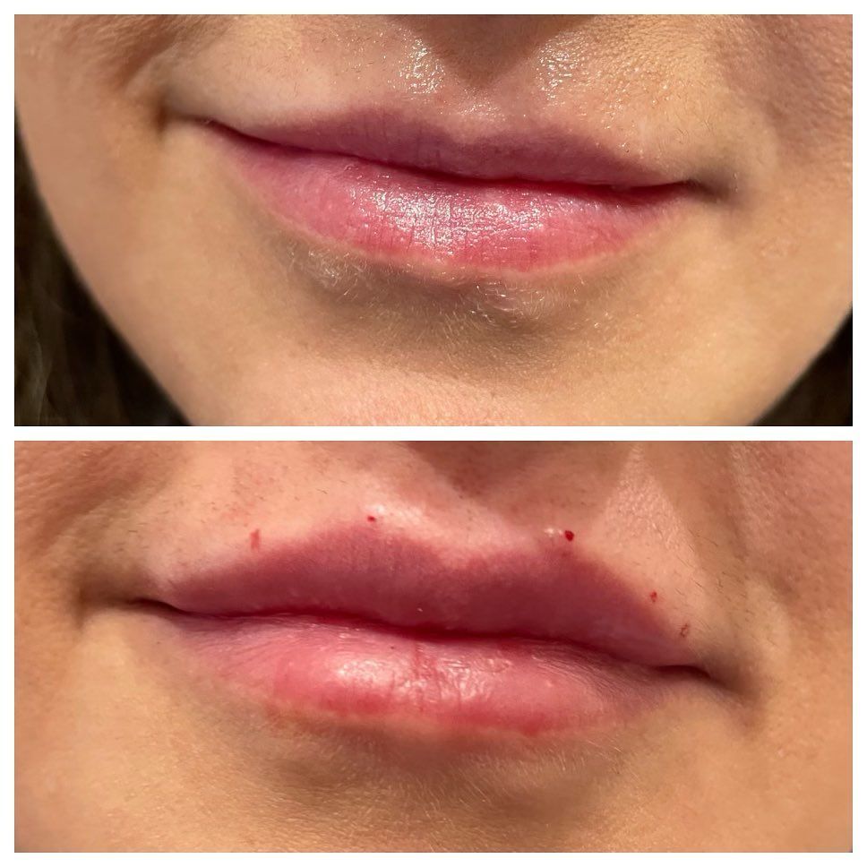 Juvederm lip augmentation before and after