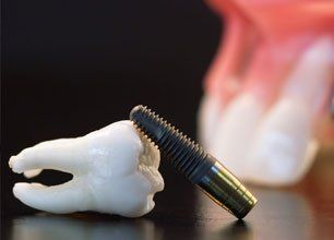 Dental Implants