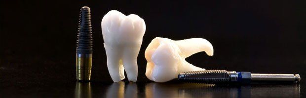 Dental implants