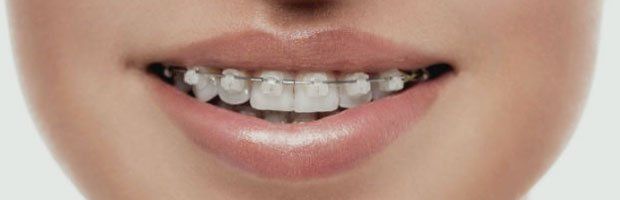 Braces