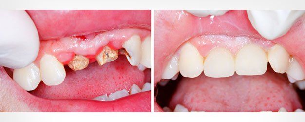 tooth restoration before and after treatment