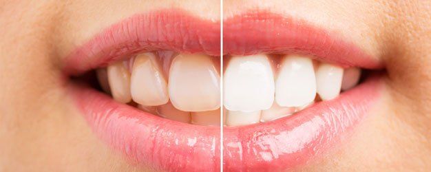Teeth before and after whitening