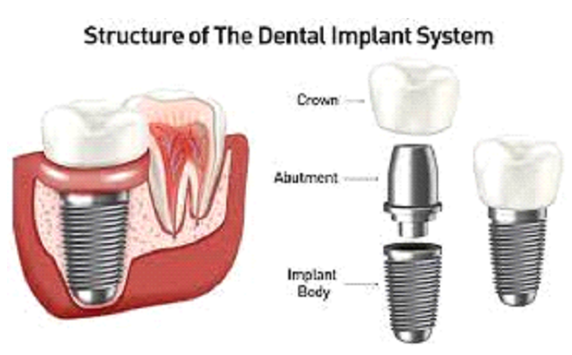 Structure of the dental implant system