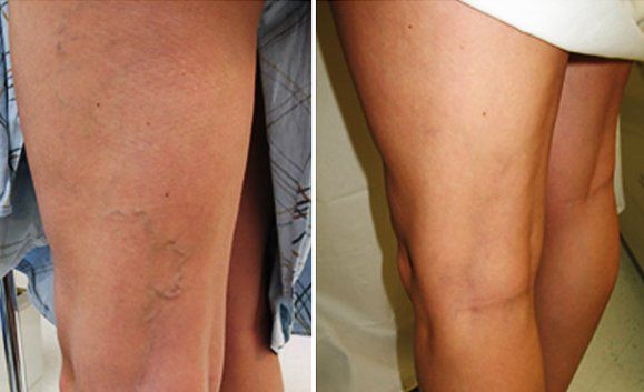 Close-up of legs with visible varicose veins, shown side by side before and after treatment.