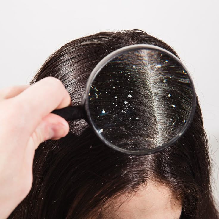 Person's dark hair scalp with white flakes visible through a magnifying glass.