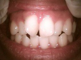 Before-tooth21058