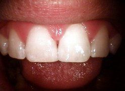 After-tooth11083