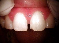 Before-tooth11078