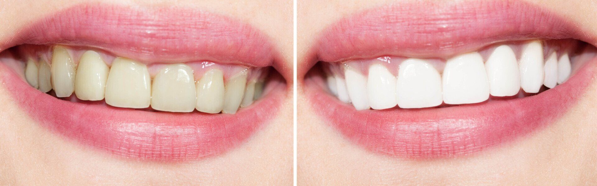 best teeth whitening treatment